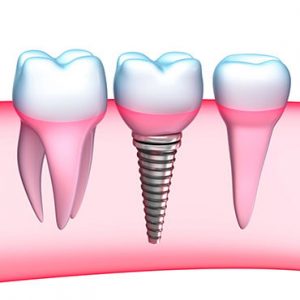 dental med keele and finch services dental implants bg image