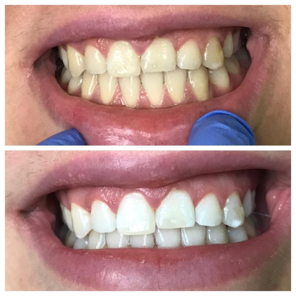 before and after image of zoom teeth whitening