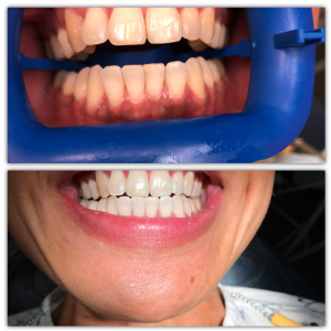 before and after image of zoom teeth whitening