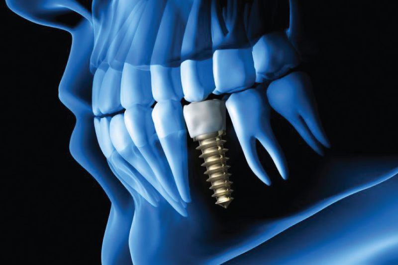 Dental Implants Dental Med Family And Cosmetic Dentistry North York Toronto Dentist other services